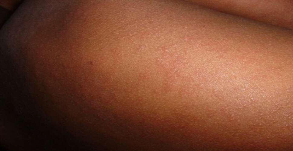 बांग्लादेश में खसरे का प्रकोप जारी, मार्च से अब तक 631 मासूमों की मौत