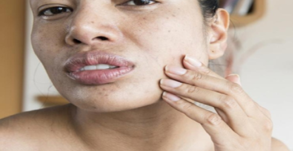 समय से पहले मुरझा रही है त्वचा, अधूरी नींद है झुर्रियों का असली कारण