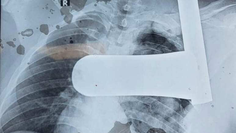 उदयपुर में डॉक्टरों ने किया चमत्कार, युवक के सीने से निकाला 9 इंच लंबा लोहे का पाइप, बचाई जान