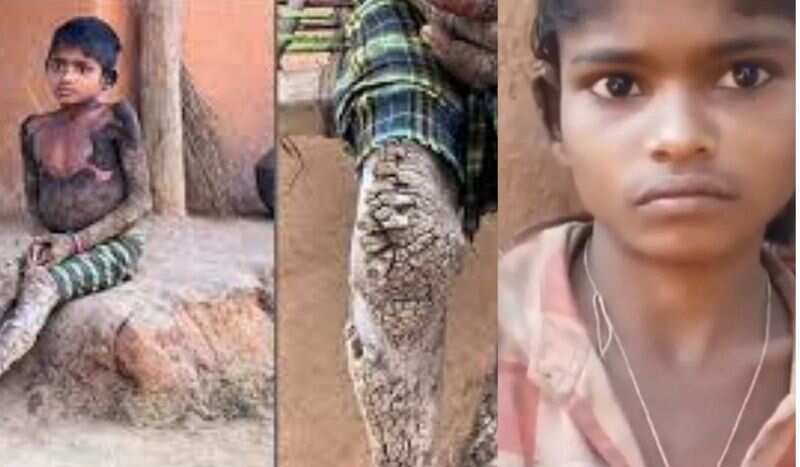 वीडियो में देंखे राजस्थान में 9 साल के बच्चे में सामने आई दुर्लभ “स्टोन मैन सिंड्रोम”