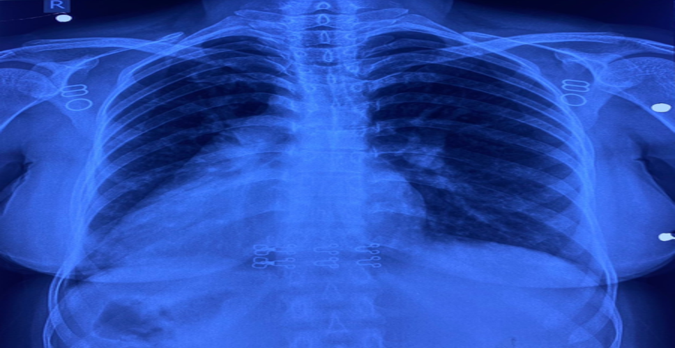 नई दिल्ली : आरएमएल अस्पताल की बड़ी सफलता, कार्डियक सर्जरी टीम ने सम्पन्न की जटिल सर्जरी