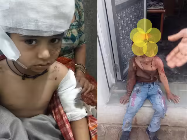 बीकानेर में स्कूल के पहले दिन 4 साल के मासूम पर आवारा कुत्तों का हमला, फुटेज में देंखे हालत गंभीर