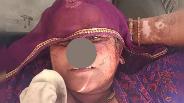 पारिवारिक विवाद में दामाद ने सास की नाक काटी, फरार