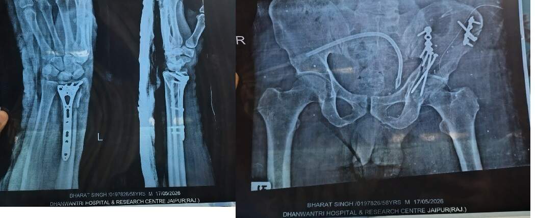 SMS अस्पताल में इलाज पर सवाल: एक्सक्लूसिव फुटेज में जाने ऑपरेशन के नाम पर पैसे मांगने और बिना सर्जरी डिस्चार्ज का आरोप, परिजनों में आक्रोश