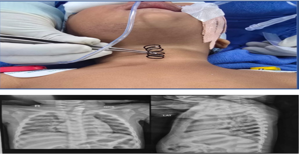 एम्स के डॉक्टरों ने 14 महीने के बच्चे की फूड पाइप से 2 इंच लंबा मेटल स्प्रिंग निकाला