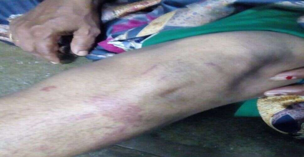 मारपीट में व्यक्ति का हाथ टूटा, 10 दिन बाद भी आरोपी गिरफ्त से बाहर, न्याय की गुहार लेकर एसपी ऑफिस पहुंचा पीड़ित