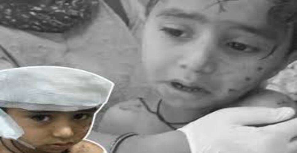 स्कूल के पहले दिन मासूम पर आवारा कुत्तों ने हमला, बच्चा गंभीर रूप से घायल