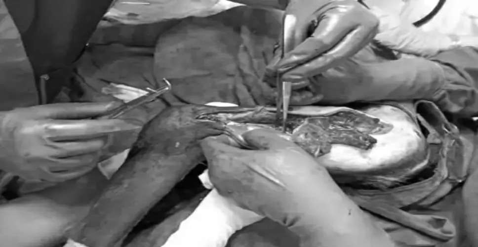 Sriganganagar में इलिजारोव विधि से सफल हुआ हड्डी के जोड़ का दूसरा ऑपरेशन, मरीज हुआ ठीक