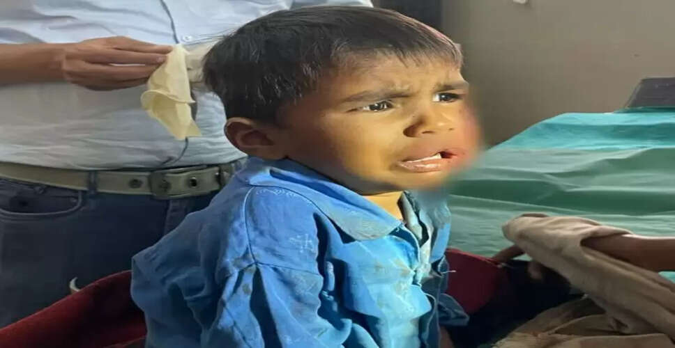 बांसवाड़ा में मासूम पर कुत्ते का हमला, चेहरे पर पांच टांके आए